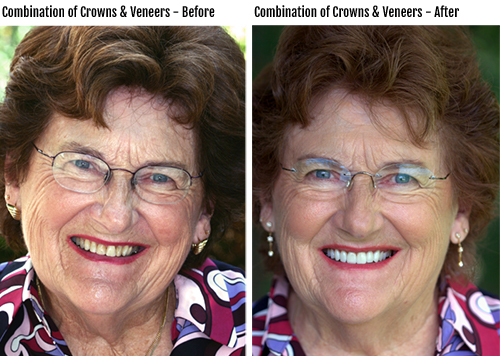 Combination of dental crowns and dental veneers before & after photo